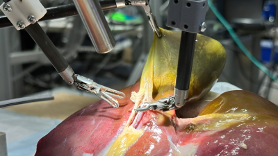 Un robot realiza la primera operación de vesícula sin asistencia humana