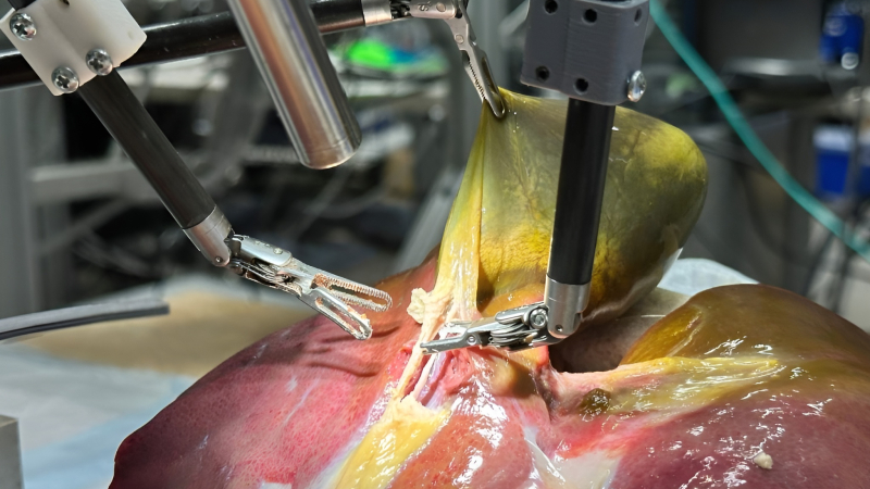 Un robot realiza la primera operación de vesícula sin asistencia humana