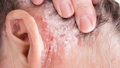 Ansiedad y depresión, otros impactos de la psoriasis grave