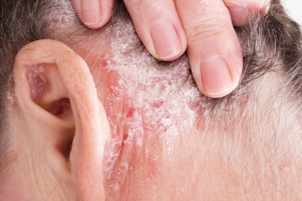 psoriasis_grave.jpg