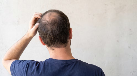 salud alopecia 1
