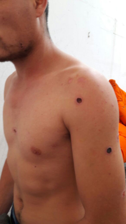 HERIDAS-BALA-DE-GOMA-.jpg