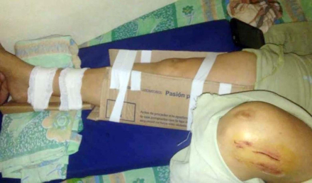 54 MUJER CON FRACTURA.JPG