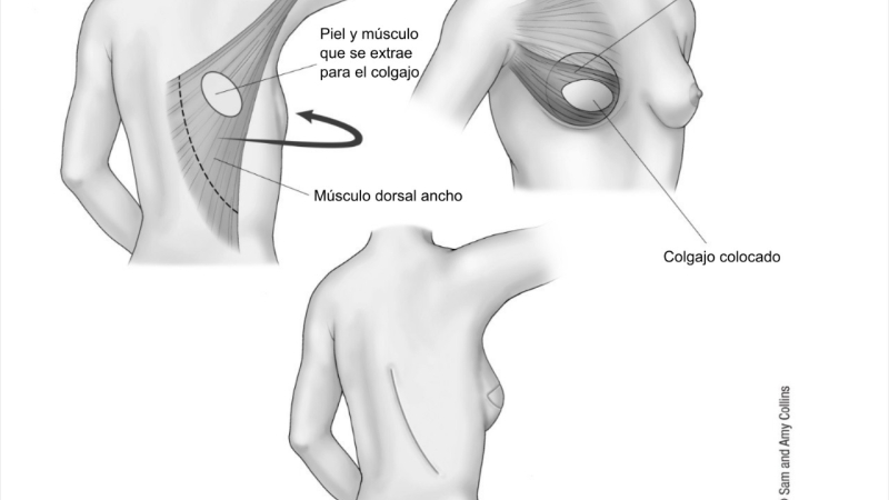 Doctor Williams Bukret: Reconstrucción mamaria