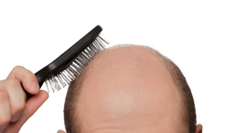 Tomar gaseosa y hacer dieta puede provocar caída del pelo