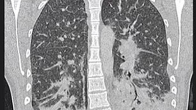 El cigarrillo electrónico le hizo sentir los pulmones como "vidrio roto"