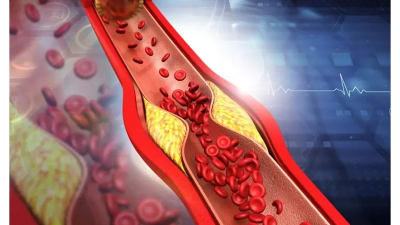 El colesterol sería siempre un riesgo para la aterosclerosis