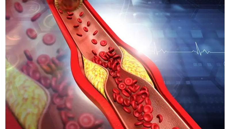 El colesterol sería siempre un riesgo para la aterosclerosis
