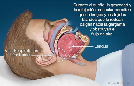 apnea2.jpg