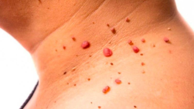 Verrugas en el cuello: por qué aparecen y cuáles son los tratamientos más comunes