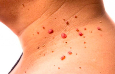 Verrugas en el cuello: por qué aparecen y cuáles son los tratamientos más comunes
