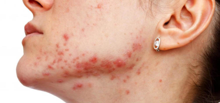 acne.jpg