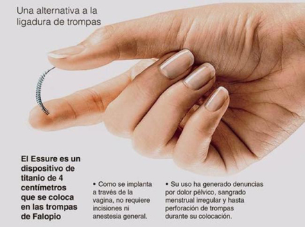 Essure.jpg