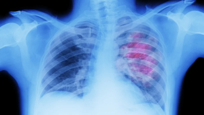 Aprueban en la Argentina un nuevo fármaco para tratar un tipo de cáncer de pulmón muy agresivo