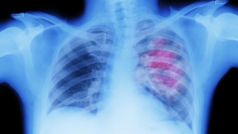 Aprueban en la Argentina un nuevo fármaco para tratar un tipo de cáncer de pulmón muy agresivo