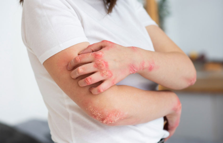 dermatitis.jpg