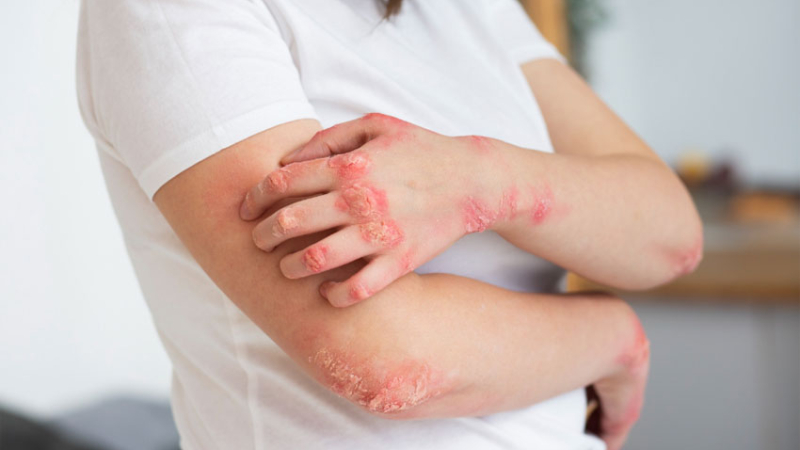 Dermatitis atópica: no es un tema menor y afecta la calidad de vida