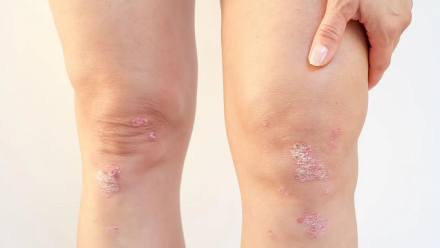 psoriasis2.jpg