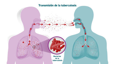 Aumento de los casos de tuberculosis