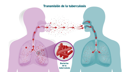 Tuberculosis.jpg