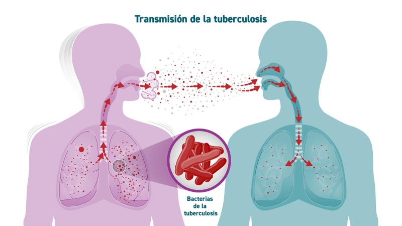 Aumento de los casos de tuberculosis