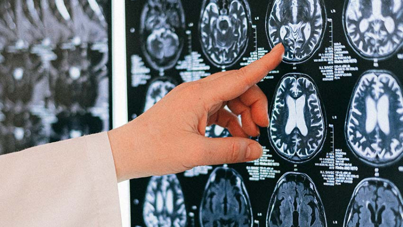 El impacto del COVID en el cerebro: detectan atrofia leve y cambios estructurales después de la infección