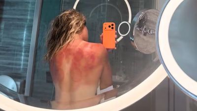 La imagen de la tenista mexicana con la espalda quemada activó las alarmas en la previa del Abierto de Australia