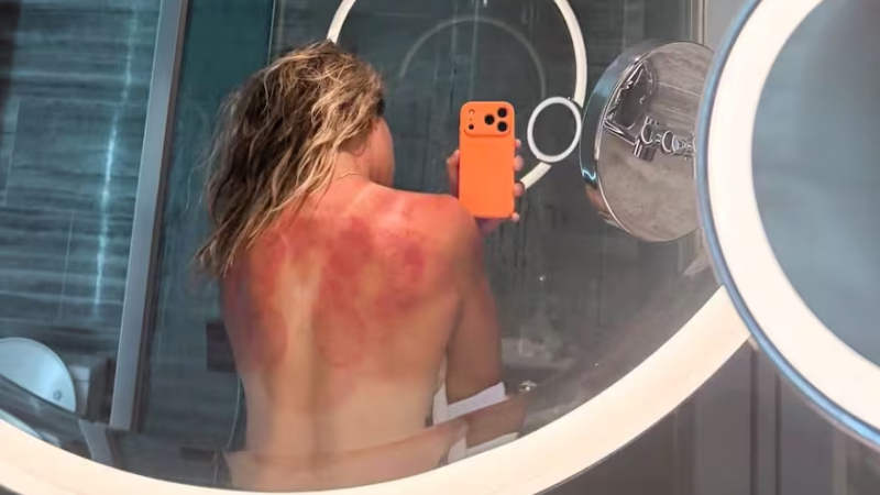La imagen de la tenista mexicana con la espalda quemada activó las alarmas en la previa del Abierto de Australia