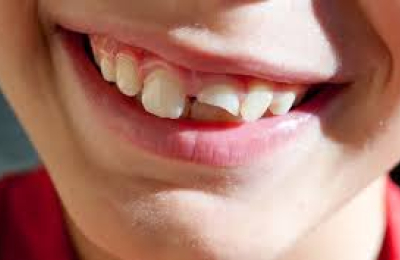 Traumatismos dentales en la infancia, un problema más frecuente de lo pensado