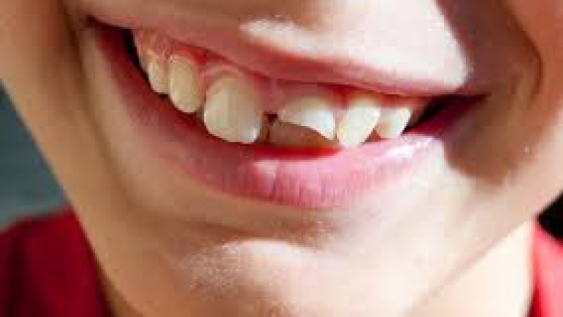 Traumatismos dentales en la infancia, un problema más frecuente de lo pensado