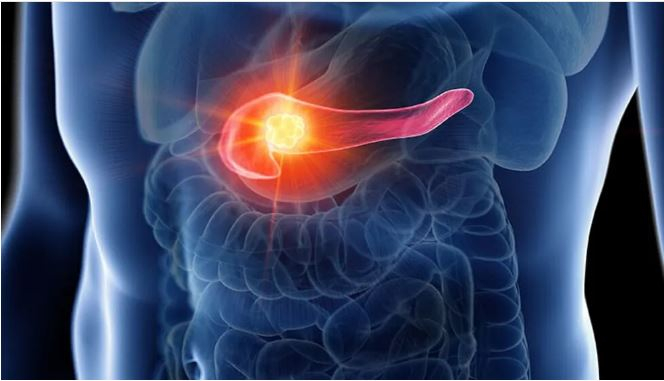 cancer de pancreas 1.JPG