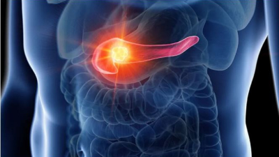 Científicos españoles logran frenar por primera vez el cáncer de páncreas en ratones