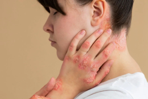 Psoriasis: que haya poca piel afectada no siempre significa una enfermedad leve