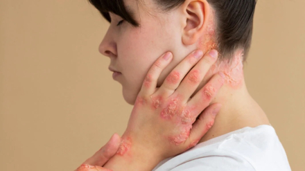 15 - salud psoriasis 2