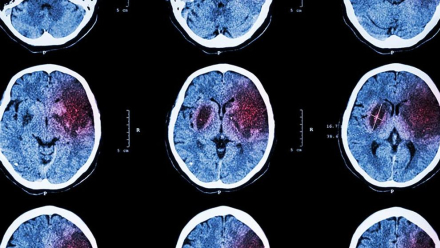 img_efreire_20190403-151039_imagenes_lv_terceros_accidente_cerebrovascular-kPTD-U461445784865OBH-992x558@LaVanguardia-Web.jpg