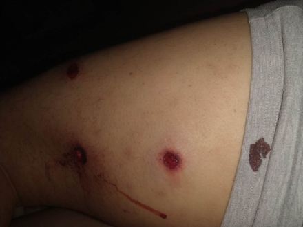 58heridas bala de goma.jpeg