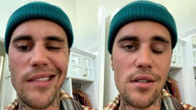 Qué es el síndrome de Ramsay Hunt, el padecimiento de Justin Bieber
