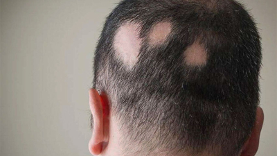 Pérdida de cabello: en qué casos amerita una consulta con el médico