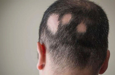 Pérdida de cabello: en qué casos amerita una consulta con el médico