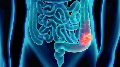Invitan a una charla sobre cáncer de colon en Resistencia