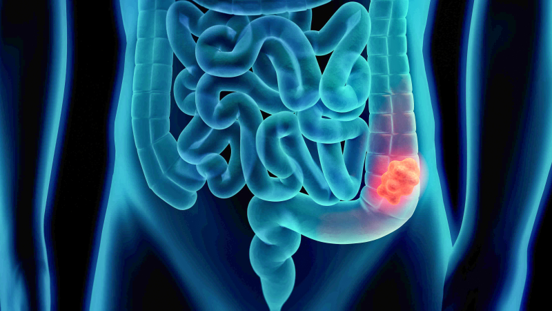Invitan a una charla sobre cáncer de colon en Resistencia