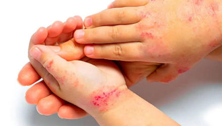 dermatitis2.jpg