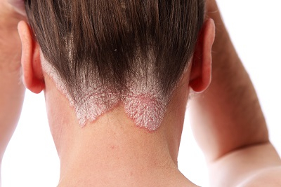 psoriasis1.jpg