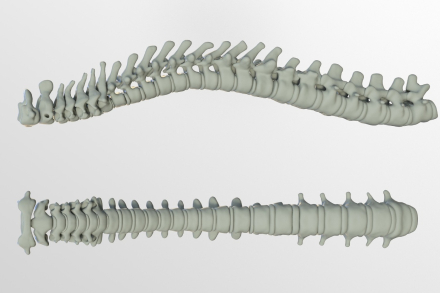 escoliosis.jpg