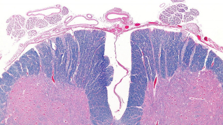 tipos-de-mielitis-wide.jpg