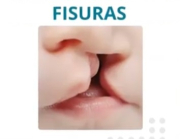 fisuras