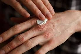 psoriasis2