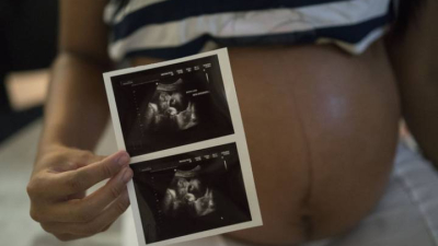 Un estudio muestra que el Zika puede causar abortos o tejido cerebral blando en bebés