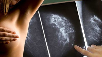 Cáncer de mama: diagnostican dos nuevos casos por hora en la Argentina