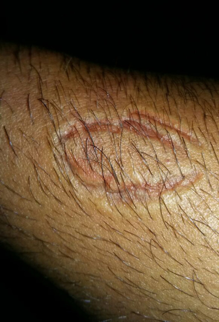 brazo-mordido.jpg